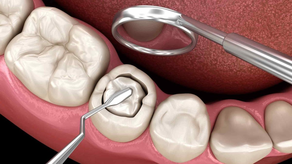Are Dental Fillings Painful What to Expect Before, During & After Treatment