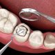 Are Dental Fillings Painful What to Expect Before, During & After Treatment