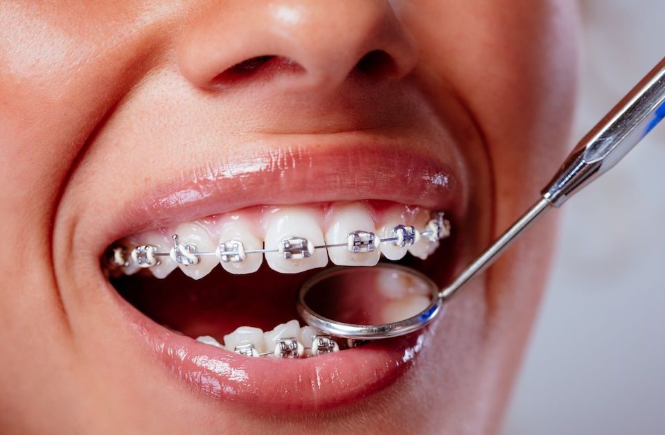 How Dentists Put on Braces Step-by-Step Process Explained