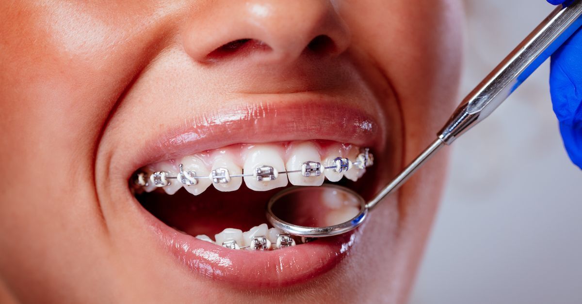 How Dentists Put on Braces Step-by-Step Process Explained