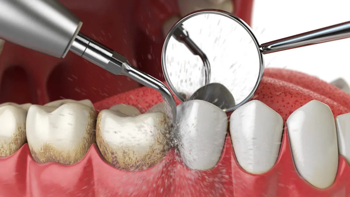 How Long Does Cleaning Take at the Dentist A Complete Time Breakdown