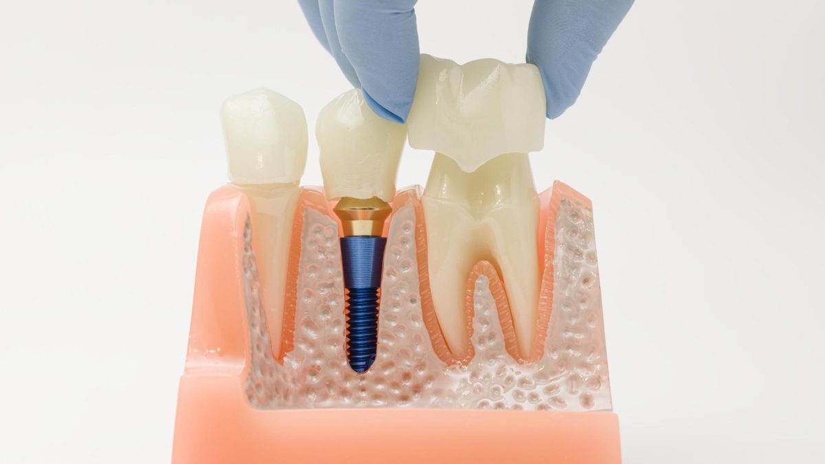 How Much for Dental Implants in NZ Cost, Factors & What to Expect