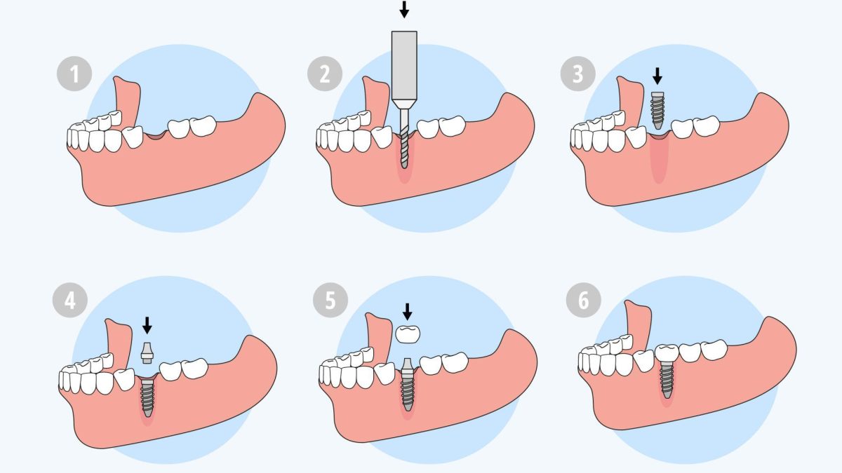 Why Do Dental Implants Take So Long A Complete Timeline Explained