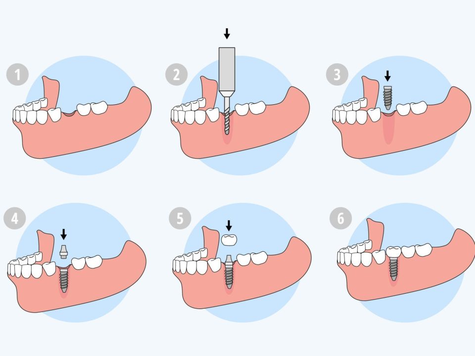 Why Do Dental Implants Take So Long A Complete Timeline Explained