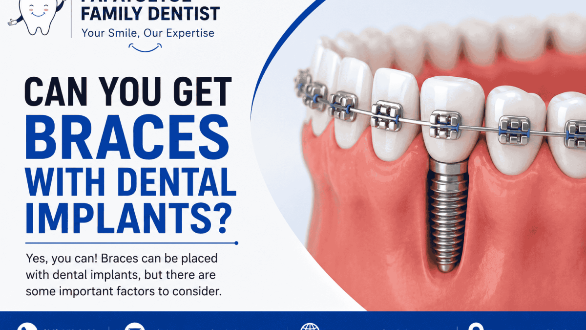 Can You Get Braces With Dental Implants